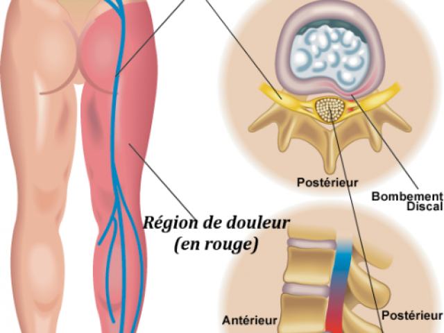 Hernies discales et ostéopathie : une approche naturelle pour soulager la douleur