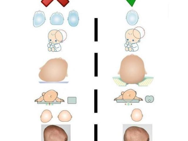 Qu'est-ce qu'une plagiocéphalie et pourquoi faire appel à un ostéopathe ?